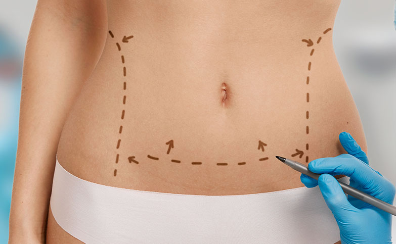 Abdominoplastia_procedimentos
