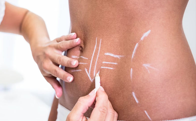 Lipo_procedimentos