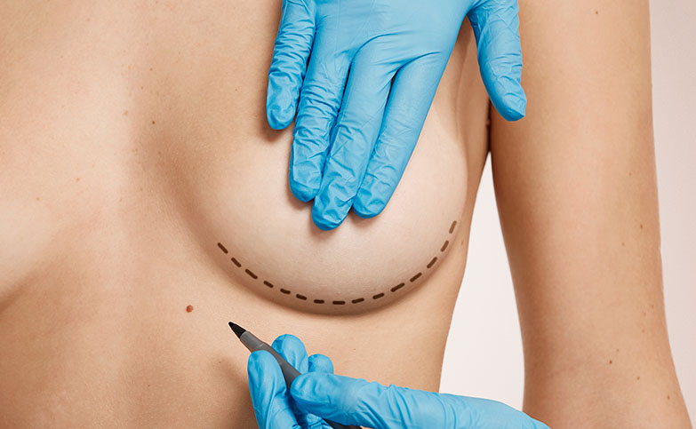 Mamoplastia